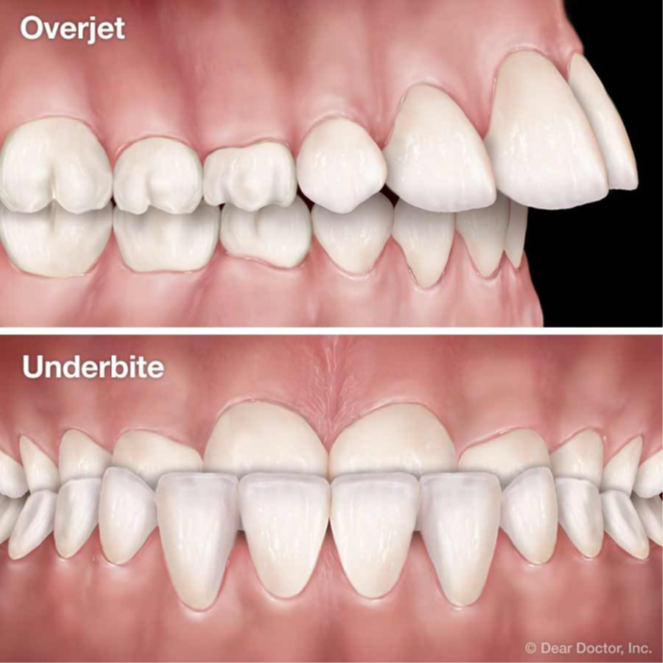 Overbite and underbite illustration