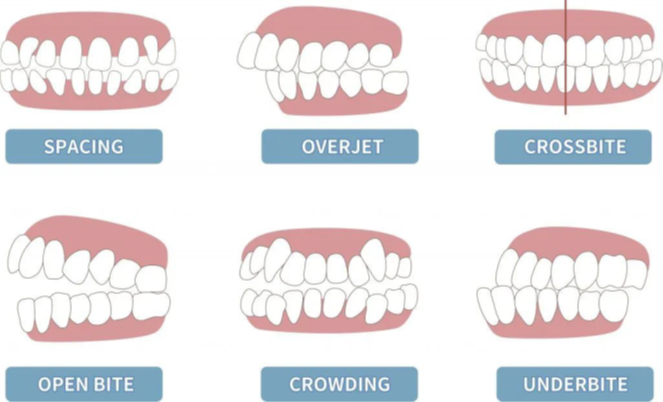 illustrated examples of teeth needing braces