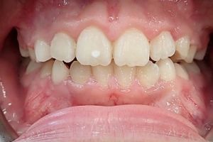 Up-close photo of mouth after treatment
