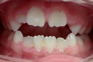 Up-close photo of mouth before treatment