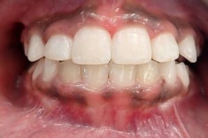 Up-close photo of mouth after treatment