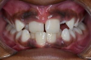 Up-close photo of mouth before treatment