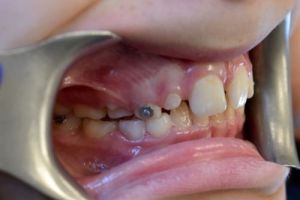 Up-close photo of mouth after treatment