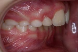 Up-close photo of mouth before treatment