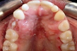 Up-close photo of mouth after treatment