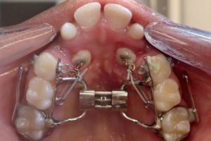 Up-close photo of mouth before treatment