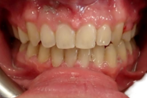 Up-close photo of mouth after treatment