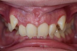 Up-close photo of mouth before treatment