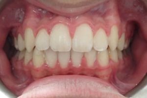 Up-close photo of mouth after treatment