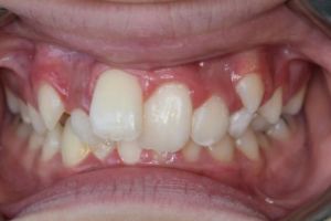 Up-close photo of mouth before treatment