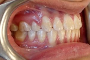 Up-close photo of mouth after treatment