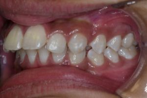 Up-close photo of mouth before treatment