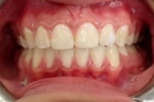 Up-close photo of mouth after treatment