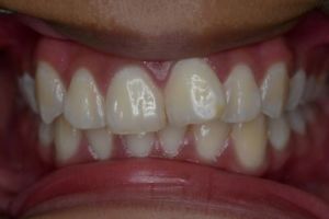 Up-close photo of mouth before treatment