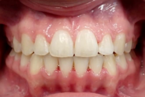 Up-close photo of mouth after treatment