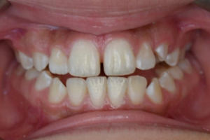 Up-close photo of mouth before treatment