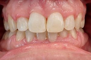 Up-close photo of mouth after treatment