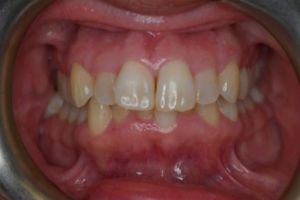 Up-close photo of mouth before treatment