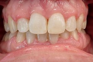 Up-close photo of mouth after treatment