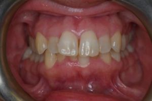 Up-close photo of mouth before treatment