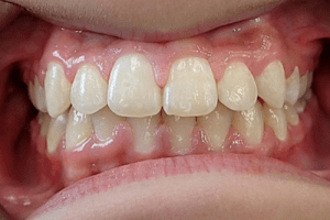 Up-close photo of mouth after treatment