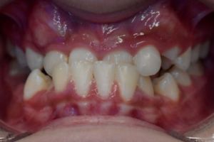 Up-close photo of mouth before treatment